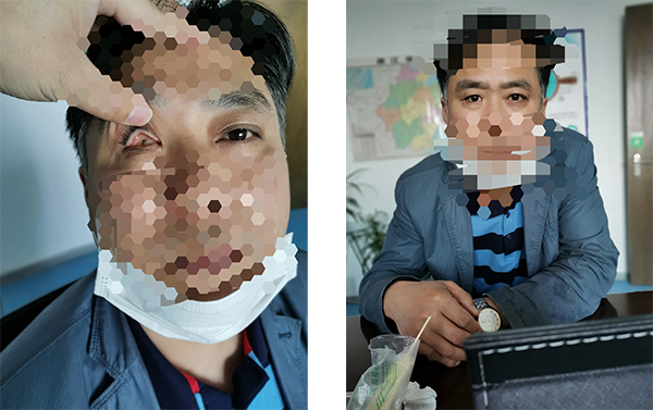 盈目义眼成功案例