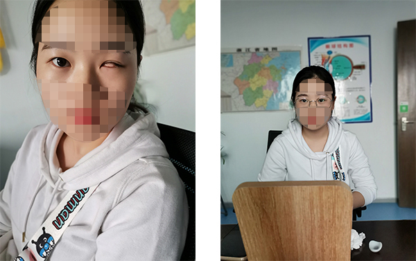 盈目义眼成功案例