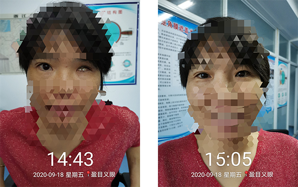 盈目义眼成功案例