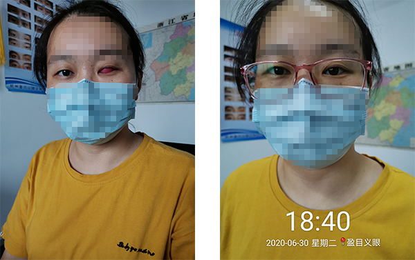 盈目义眼成功案例