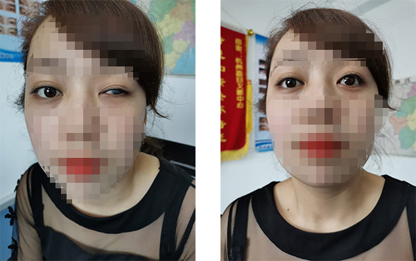 盈目义眼成功案例
