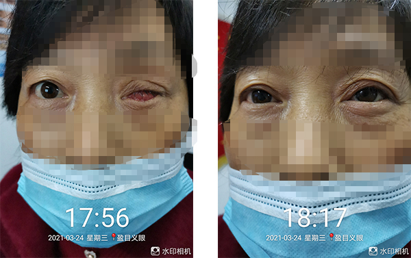 盈目义眼成功案例